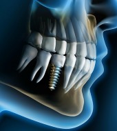 implant-rendering