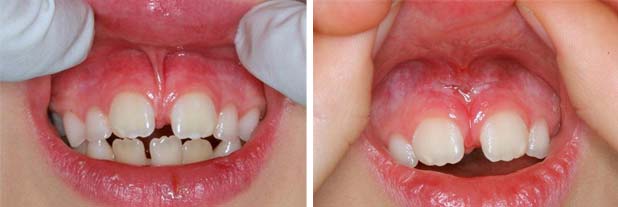 Frenectomy-Before-and-After