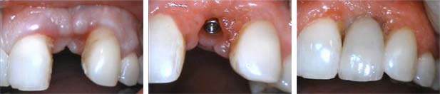 Implant-Before-and-After