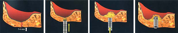 Osteotome