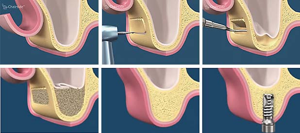 Sinus-Lift-Lateral