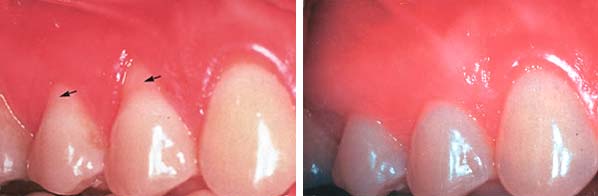 Tissue-Graft-Before-and-After