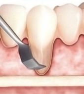 Alloderm Diagram