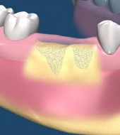 Bone Grafting