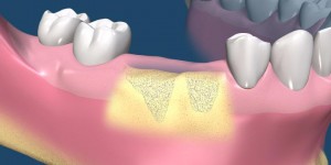 Bone Grafting