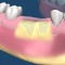 Bone Grafting