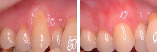 Graft Before and After