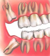 Impacted Wisdom Teeth