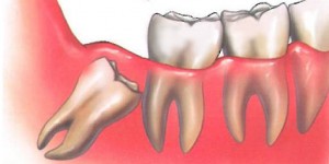 Impacted Wisdom Teeth