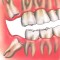 Impacted Wisdom Teeth