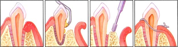 Osseous Surgery Diagram