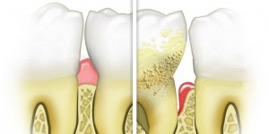 Healthy versus diseased gums