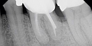 root-fracture-1