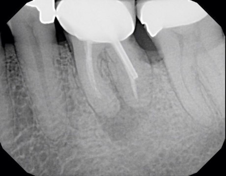 root-fracture-1