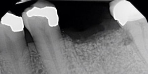 root-fracture-2