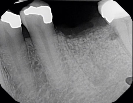 root-fracture-2