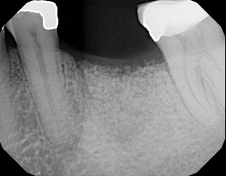 root-fracture-3