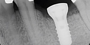 root-fracture-4