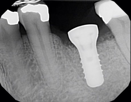 root-fracture-4