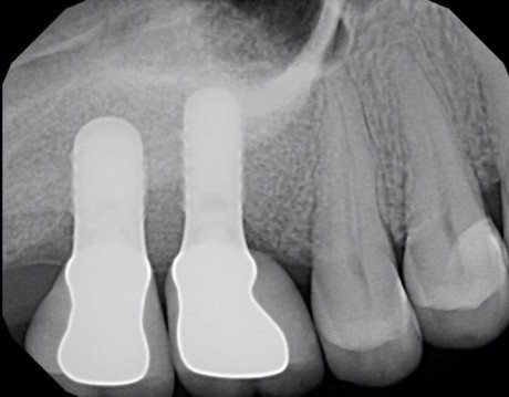 sinus-lift-4